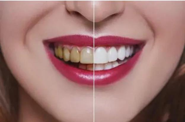 6種網上瘋傳的牙齒美白小(xiǎo)秘方，真的有效果嗎？
