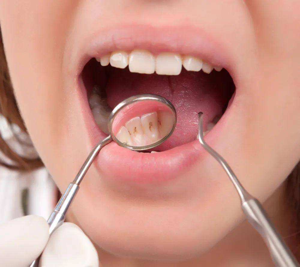 口腔大(dà)作戰，如(rú)何清除口腔細菌之牙菌斑