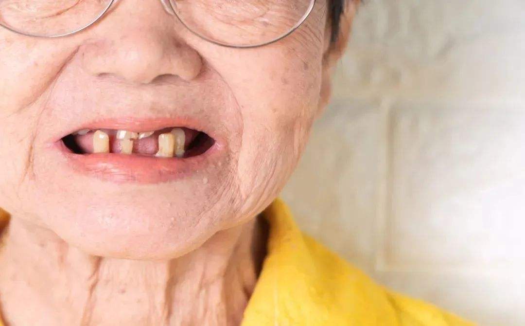 老年人安裝什麼假牙好(hǎo)？聽聽醫生的說(shuō)法